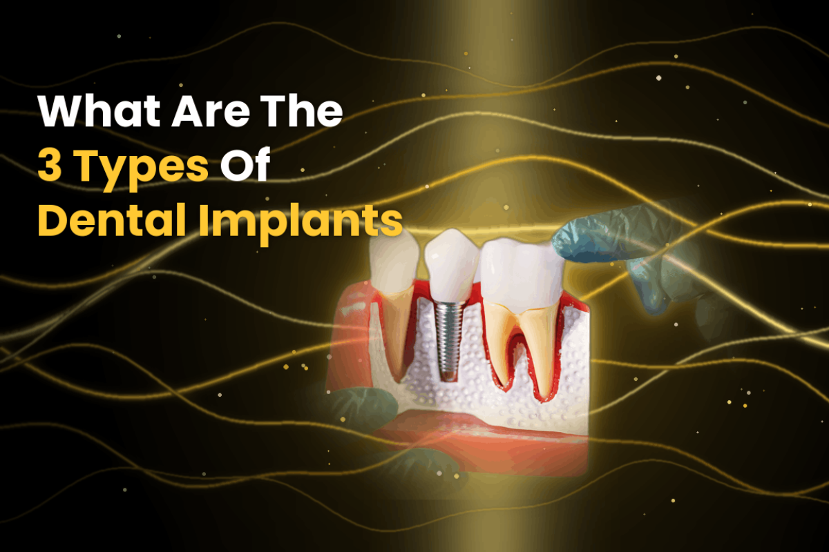 What Are The 3 Types Of Dental Implants? What Are The 3 Types Of Dental Implants?